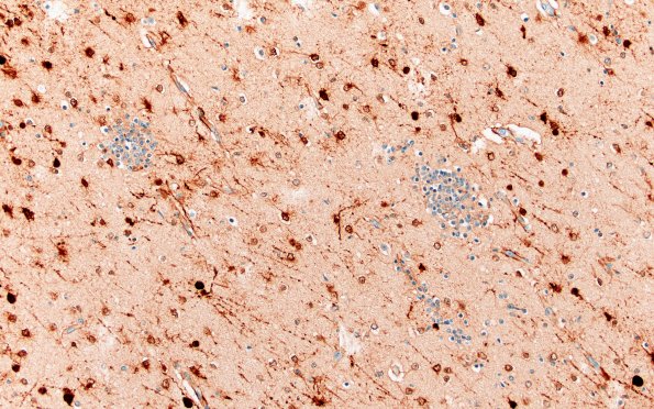 5N4 Malformation (Case 5) S100 20X 2