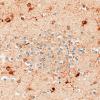 5N5 Malformation (Case 5) S100 40X 1