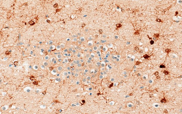 5N5 Malformation (Case 5) S100 40X 1