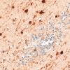 5N6 Malformation (Case 5) S100 40X 2