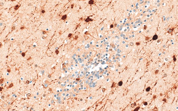 5N6 Malformation (Case 5) S100 40X 2