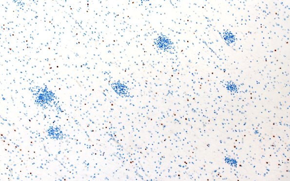 5O3 Malformation (Case 5) SOX10 10X 2