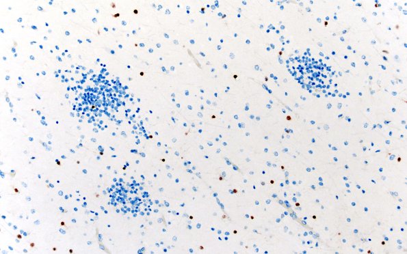 5O4 Malformation (Case 5) SOX10 20X