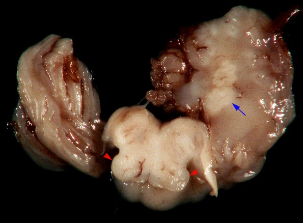 1A Malformation, ION (Case 1) N8 ION and dentate dysplasia