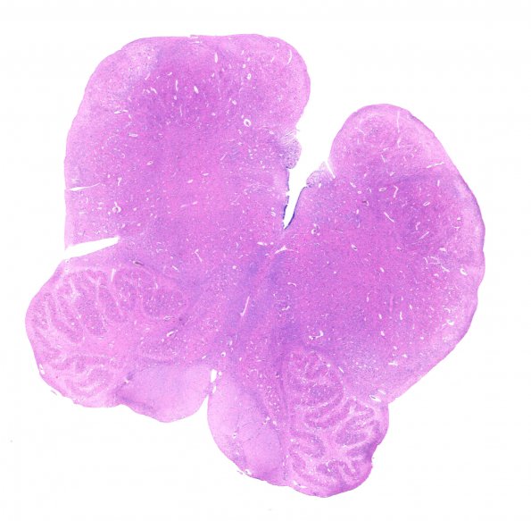 1B1 Malformation, ION (Case 1) N10 ION dysplasia whole mount  2