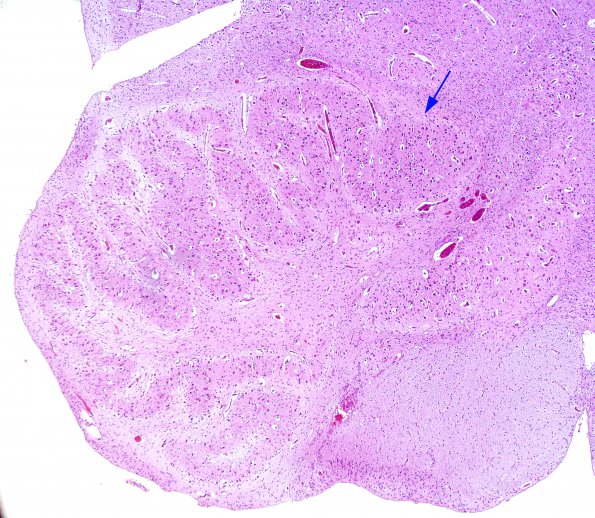 1B2 Malformation, ION (Case 1) N10 ION dysplasia abnormal side A