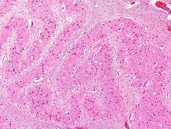 1B3 Malformation, ION (Case 1) N8 ION dysplasia 2