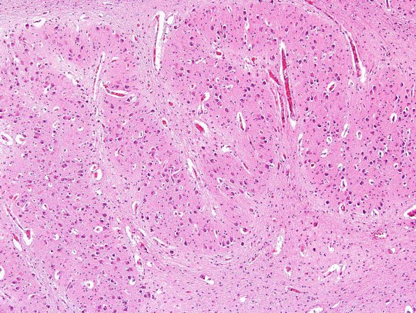 1B4 Malformation, ION (Case 1) N10 ION dysplasia 10X