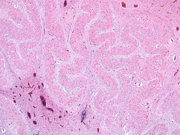 1B5 Malformation, Dentate nucleus (Case 1) H&E 1