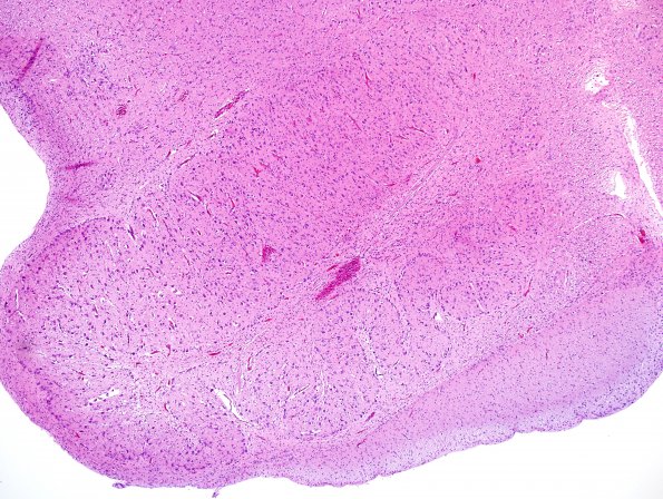 2A2 ION, dysplasia dorsal part, Trisomy 18 N8 (Case 2) H&E 1