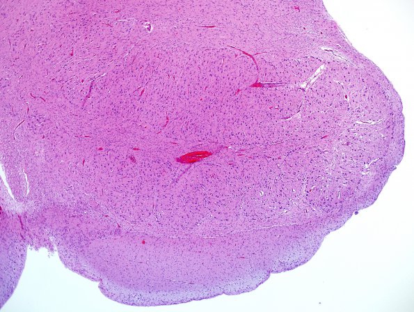 2A3 ION, dysplasia dorsal part, Trisomy 18 N8 (Case 2) H&E 2.