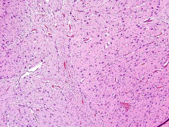 2A4 ION, dysplasia dorsal part, Trisomy 18 (Case 2) H&E 3