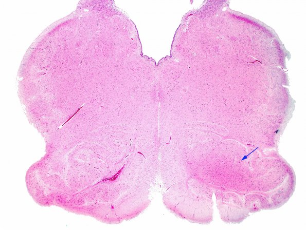 3A1 Medulla (Case 3) H&E 2X