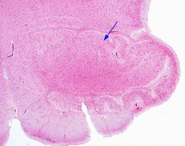 3A2 Medulla (Case 3) H&E 4X