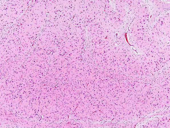 3A3 Medulla (Case 3) H&E 10X