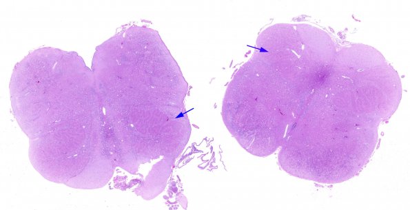 4A1 Olivary Dysplasia, Non-ketotic hyperglycinemia (Case 4) H&E whole mountA