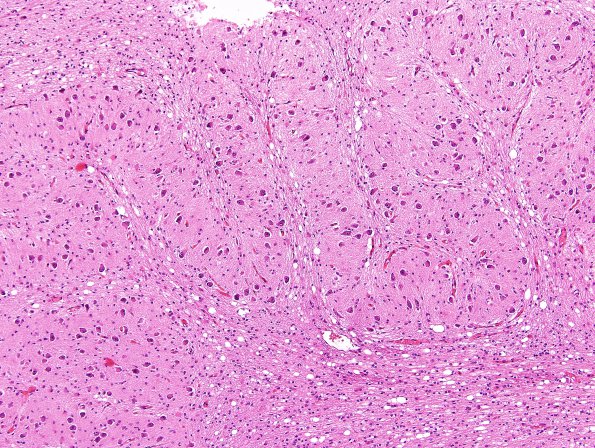 4A3 Olivary Dysplasia, Non-ketotic hyperglycinemia (Case 4) H&E 10X