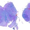 4B1 Olivary Dysplasia, Non-ketotic hyperglycinemia (Case 4) LFB-PAS whole mount