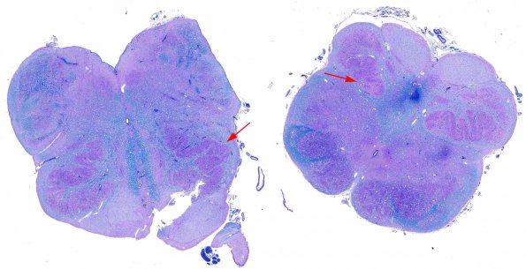 4B1 Olivary Dysplasia, Non-ketotic hyperglycinemia (Case 4) LFB-PAS whole mount