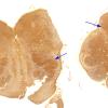 4B2 Olivary Dysplasia, Non-ketotic hyperglycinemia (Case 4) Biels whole mount