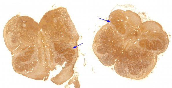 4B2 Olivary Dysplasia, Non-ketotic hyperglycinemia (Case 4) Biels whole mount