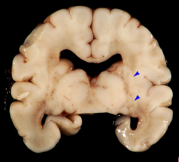 1B1 Malformations, Trisomy (69,XXY) (Case 1) Gross_6