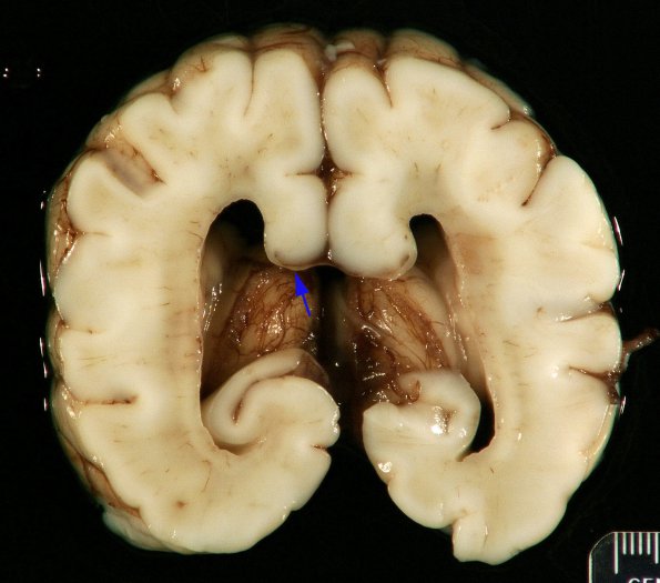 1B2 Malformations, Trisomy (69,XXY) (Case 1) Gross_7