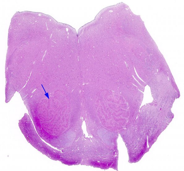 1C1 Malformations, Trisomy (69,XXY) (Case 1) Gross_N8 1