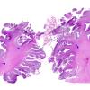 1C3 Malformations, Trisomy (69,XXY) (Case 1) N9 H&E whole moun