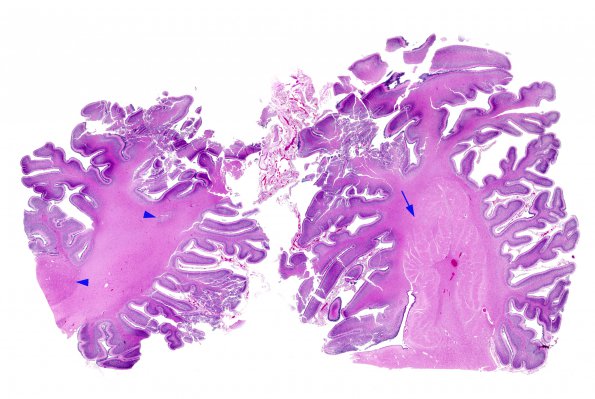 1C3 Malformations, Trisomy (69,XXY) (Case 1) N9 H&E whole moun