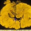 1A3 Meckel syndrome (Case 1) 6