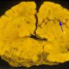 1A4 Meckel syndrome (Case 1) 4