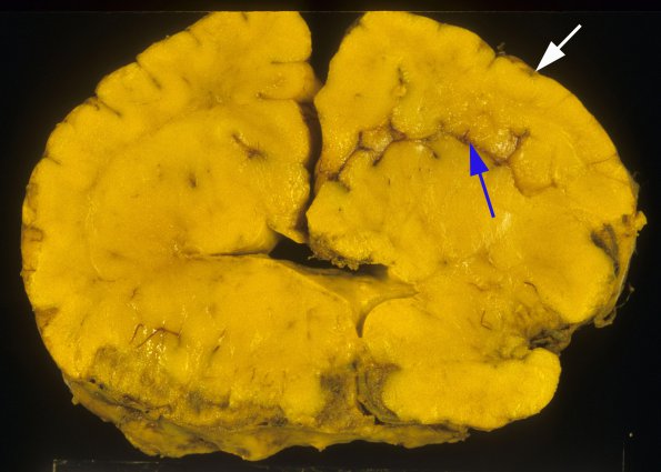 1A4 Meckel syndrome (Case 1) 4