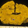 1A5 Meckel syndrome (Case 1) 11