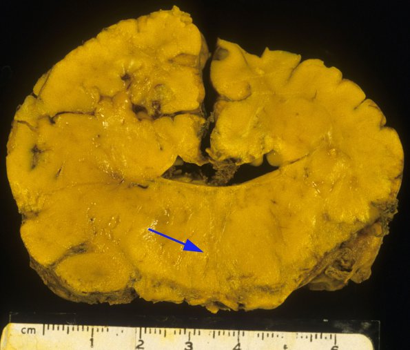 1A5 Meckel syndrome (Case 1) 11