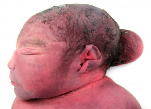 3A1 Encephalocele, Meckel-Gruber (Case 3) _1