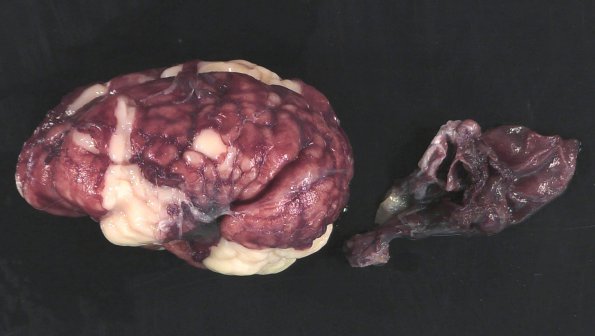 3B1 Encephalocele, Meckel-Gruber (Case 3)  _7