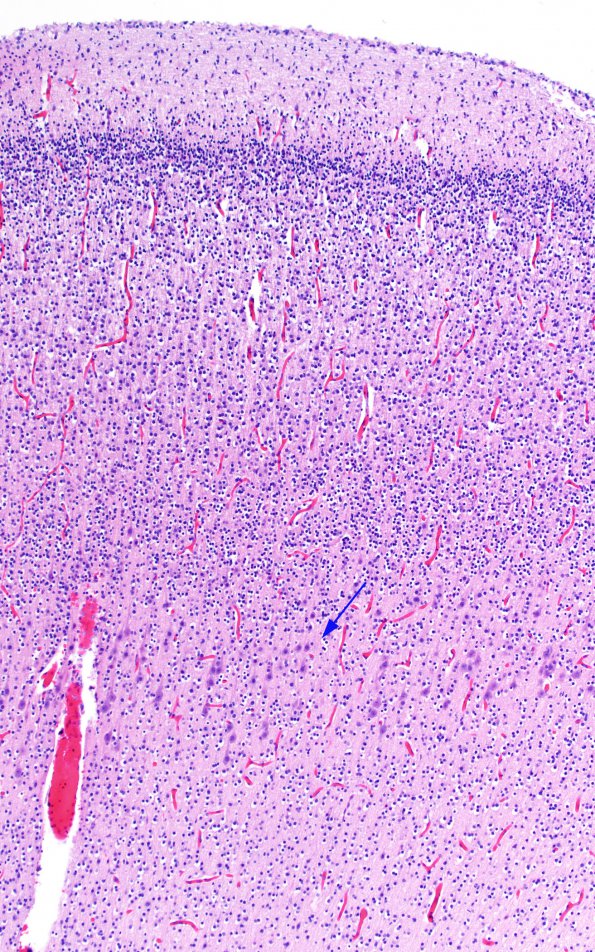 3C1 Encephalocele, Meckel-Gruber syndrome (Case 3) N1 H&E 1 copy