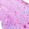 3C10 Encephalocele, Meckel-Gruber syndrome (Case 3) N11 H&E 10X 3