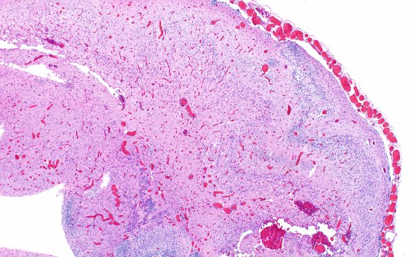 3C10 Encephalocele, Meckel-Gruber syndrome (Case 3) N11 H&E 10X 3