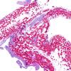 3C11 Encephalocele, Meckel-Gruber syndrome (Case 3) N16 H&E 10X 3