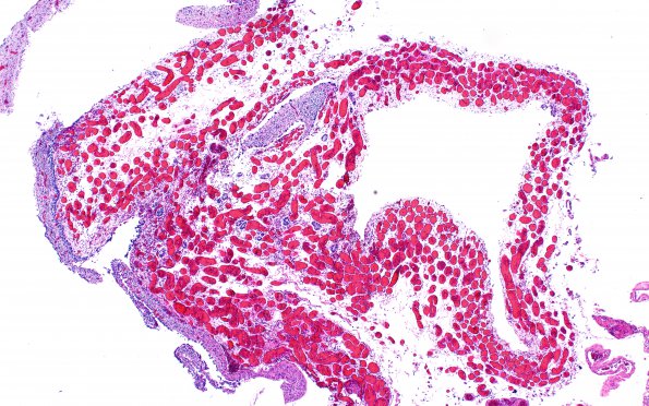 3C11 Encephalocele, Meckel-Gruber syndrome (Case 3) N16 H&E 10X 3