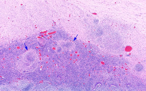 3C12 Encephalocele, Meckel-Gruber syndrome (Case 3) N9 H&E 20X copy