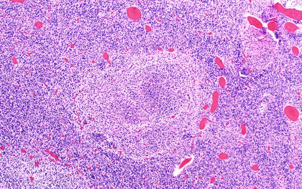 3C13 Encephalocele, Meckel-Gruber syndrome (Case 3) N9 H&E 10X 3