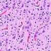 3C2 Encephalocele, Meckel-Gruber syndrome (Case 3) N1 H&E 3