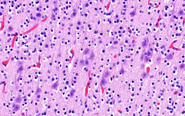 3C2 Encephalocele, Meckel-Gruber syndrome (Case 3) N1 H&E 3