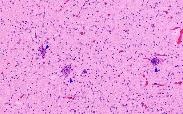 3C3 Encephalocele, Meckel-Gruber syndrome (Case 3) N6 H&E 1 copy