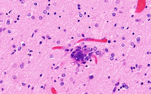 3C4 Encephalocele, Meckel-Gruber syndrome (Case 3) N6 H&E 60X