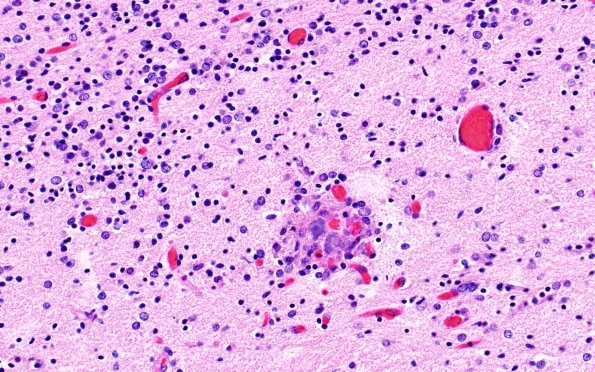 3C5 Encephalocele, Meckel-Gruber syndrome (Case 3) N1 H&E 4