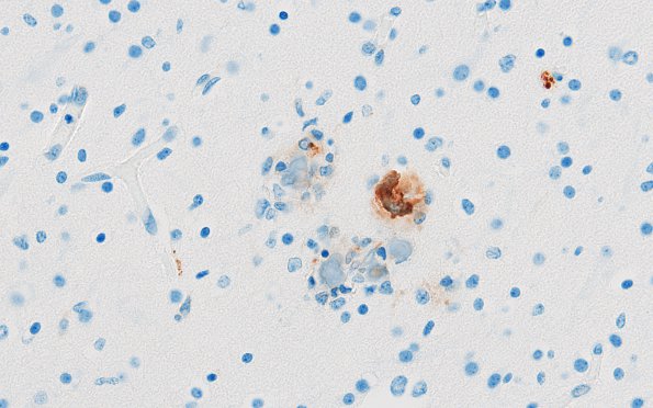 3C6 Encephalocele, Meckel-Gruber syndrome (Case 3) N6 CD68 1